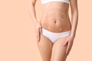 Miniabdominoplastika