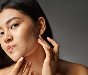 Treatment of acne